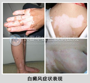 成人白斑病应该如何识别呢?