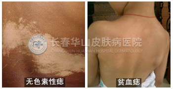 成人白斑病应该如何识别呢?